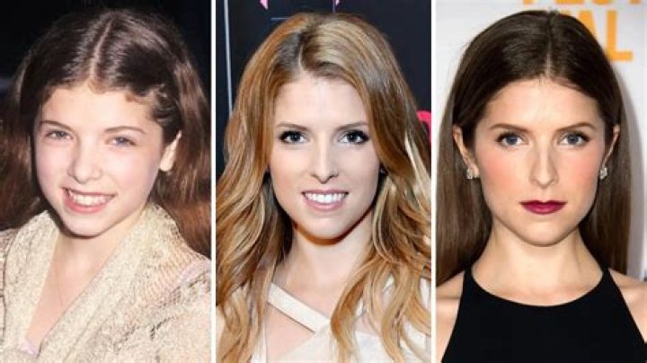 Anna Kendrick Plastic Surgery Before and After