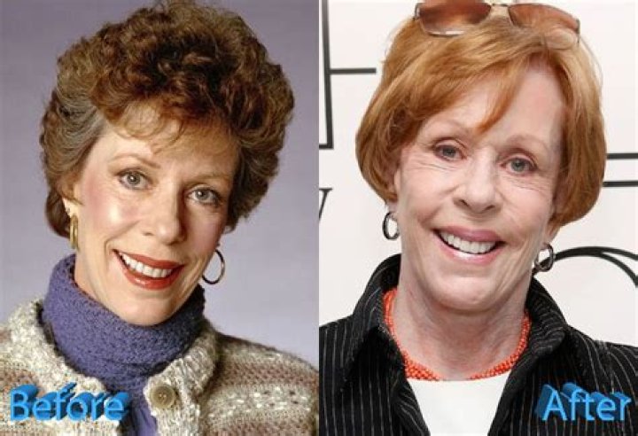 Carol Burnett Surgery : Before and After Pictures
