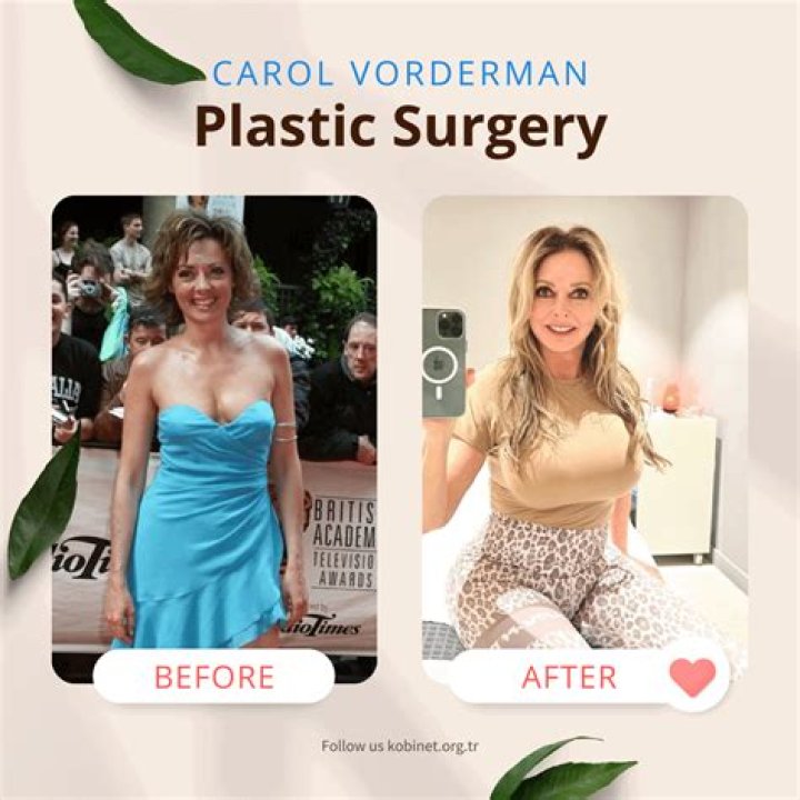 Cordol Vorderman Opens Up About Plastic Surgery: “I have Botox and alot of treatments to my face and neck”