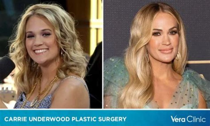 Did Carrie Underwood have plastic surgery for her lips? Before and after photos