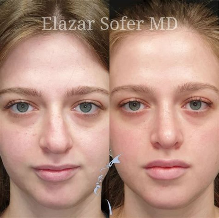 Dr. Elazar Sofer, MD – Beverly Hills, CA