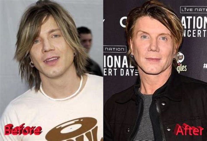 Johnny Rzeznik Plastic Surgery: A Deep Dive Into the Transformation