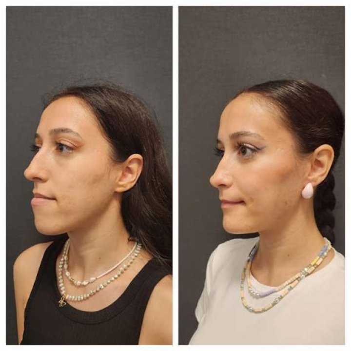 Lai Austria Real Gender: Before And After Surgery