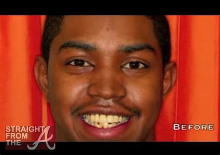 Lil Scrappy teeth: What happened to Lil Scrappy teeth? Accident explained