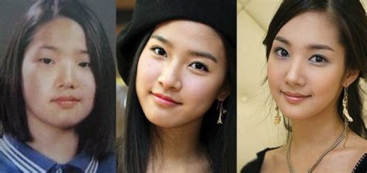 Park Min Young Plastic Surgery: The South-Korean actress Opens Up About Her Cosmetic Surgery