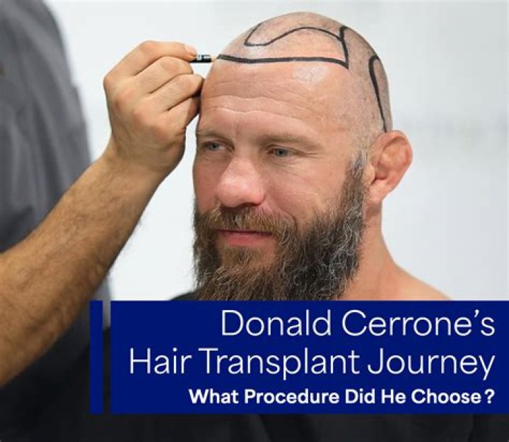 UFC Fighter Donald Cerrone Claims Hair Transplant Surgery Has Been A Blessing