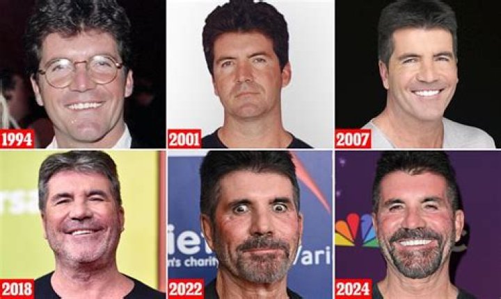 What happened to Simon Cowell’s face?